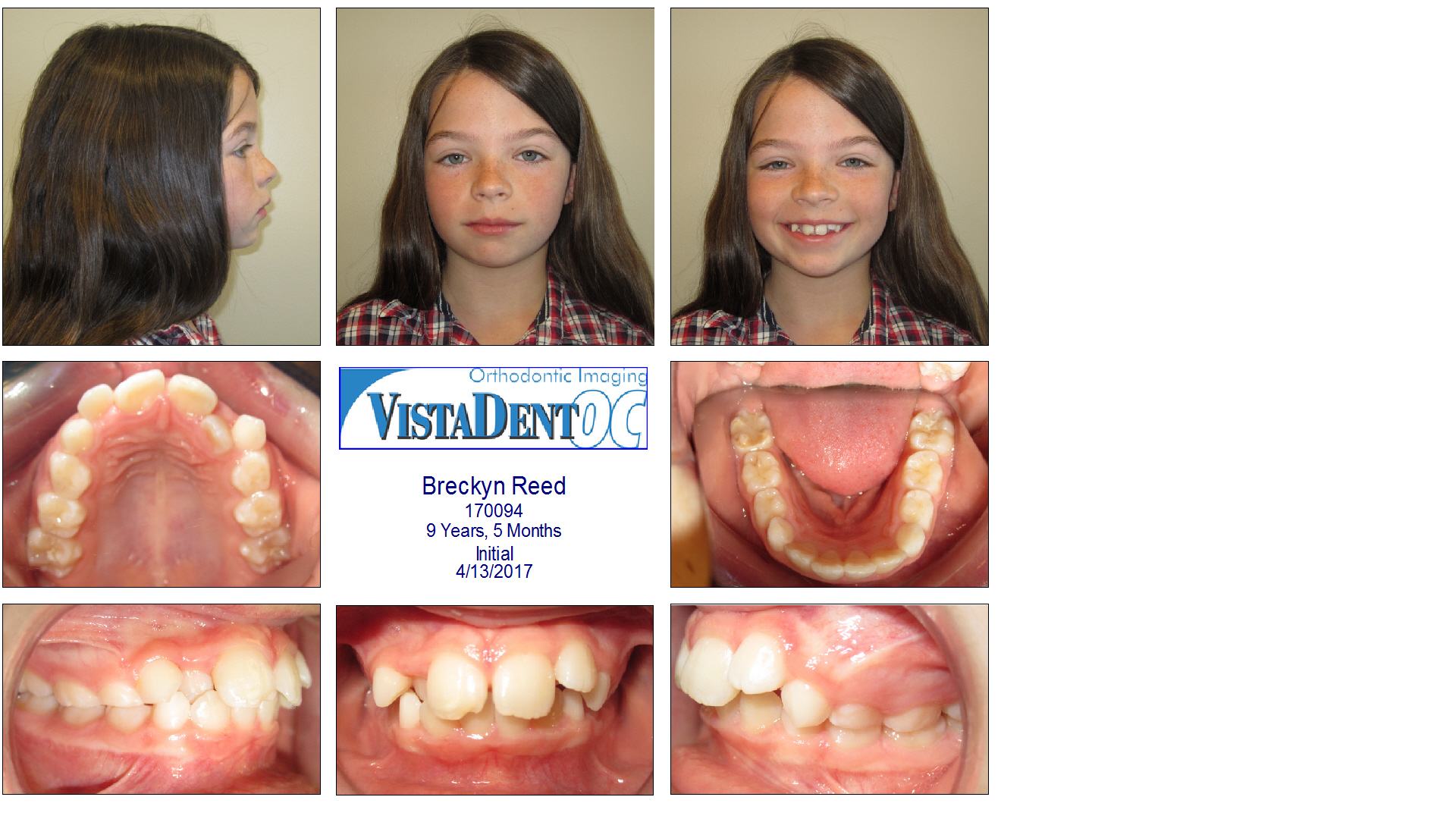 5 Reasons to See Your Orthodontist Before 5th Grade The Salt Project